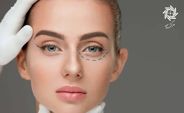بهره ‌مندی از بیمه تکمیلی برای عمل بلفاروپلاستی